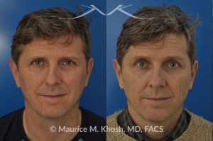 Photo of a patient before and after a procedure. Nasal valve repair