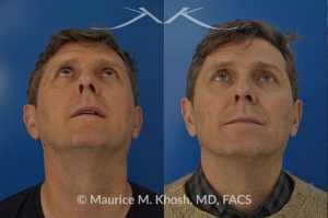 Photo of a patient before and after a procedure. Nasal valve repair