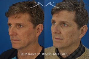 Photo of a patient before and after a procedure. Nasal valve repair