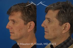 Photo of a patient before and after a procedure. Nasal valve repair