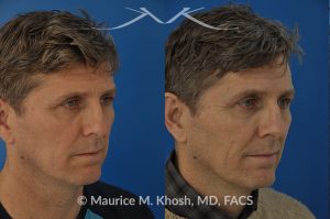 Photo of a patient before and after a procedure. Nasal valve repair