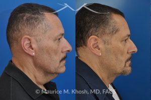 Photo of a patient before and after a procedure. Neck lift & Lipoma - Necklift performed directly through a midline neck incision. Simultaneous removal of benign fatty tumor of the neck (lipoma) through the same approach