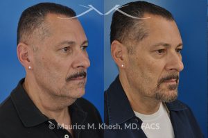 Photo of a patient before and after a procedure. Neck lift & Lipoma - Necklift performed directly through a midline neck incision. Simultaneous removal of benign fatty tumor of the neck (lipoma) through the same approach