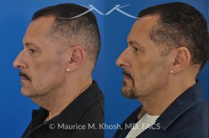 Photo of a patient before and after a procedure. Neck lift & Lipoma - Necklift performed directly through a midline neck incision. Simultaneous removal of benign fatty tumor of the neck (lipoma) through the same approach