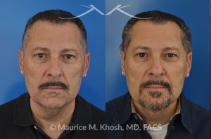 Photo of a patient before and after a procedure. Neck lift & Lipoma - Necklift performed directly through a midline neck incision. Simultaneous removal of benign fatty tumor of the neck (lipoma) through the same approach