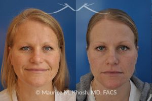 Photo of a patient before and after a procedure. Osteoma of left forehead removed