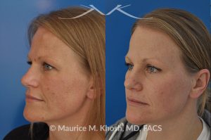Photo of a patient before and after a procedure. Osteoma of left forehead removed