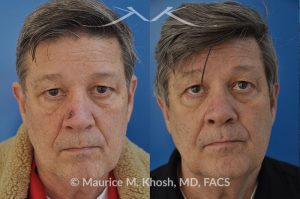 Photo of a patient before and after a procedure. Patient with basal cell skin cancer removed from the right lower nose - The nose defect was repaired with a skin graft obtained from the skin in front of the ear.