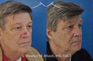 Photo of a patient before and after a procedure. Patient with basal cell skin cancer removed from the right lower nose - The nose defect was repaired with a skin graft obtained from the skin in front of the ear.