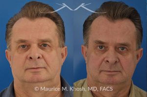 Photo of a patient before and after a procedure. Upper eyelid lift - Upper eyelid lift