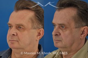 Photo of a patient before and after a procedure. Upper eyelid lift - Upper eyelid lift