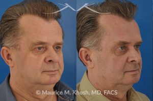 Photo of a patient before and after a procedure. Upper eyelid lift - Upper eyelid lift