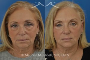 Photo of a patient before and after a procedure. Botox for the brow, and smile lines. Facial filler Voluma for the cheeks, temples, tear trough, and the side of the lower jaw. Although no eyelid surgery was performed, the lower eyelids look much younger.