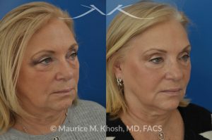 Photo of a patient before and after a procedure. Botox for the brow, and smile lines. Facial filler Voluma for the cheeks, temples, tear trough, and the side of the lower jaw. Although no eyelid surgery was performed, the lower eyelids look much younger.