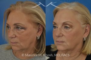 Photo of a patient before and after a procedure. Botox for the brow, and smile lines. Facial filler Voluma for the cheeks, temples, tear trough, and the side of the lower jaw. Although no eyelid surgery was performed, the lower eyelids look much younger.