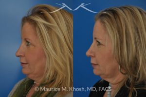 Photo of a patient before and after a procedure. Subtle rhinoplasty, nose job to fix deviation of the nasal tip, reduce a nose hump, narrow and elevate the nasal tip