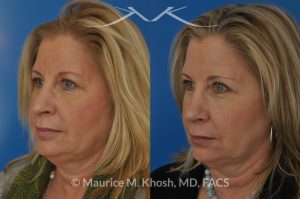 Photo of a patient before and after a procedure. Subtle rhinoplasty, nose job to fix deviation of the nasal tip, reduce a nose hump, narrow and elevate the nasal tip