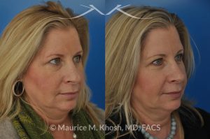 Photo of a patient before and after a procedure. Subtle rhinoplasty, nose job to fix deviation of the nasal tip, reduce a nose hump, narrow and elevate the nasal tip