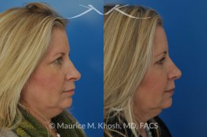 Photo of a patient before and after a procedure. Subtle rhinoplasty, nose job to fix deviation of the nasal tip, reduce a nose hump, narrow and elevate the nasal tip