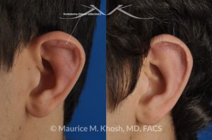 Photo of a patient before and after a procedure. Drainage - of ear blood collection, auricular hematoma