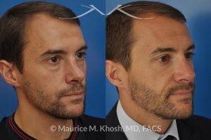 Photo of a patient before and after a procedure. Nose fracture - due to sports injury. Correction of the  deviated septum, placement of a left sided spreader graft, and right sided osteotomies to correct the displaced nasal bone