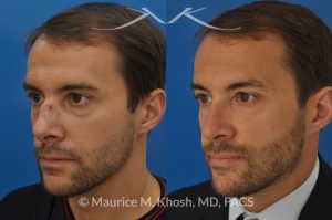 Photo of a patient before and after a procedure. Nose fracture - due to sports injury. Correction of the  deviated septum, placement of a left sided spreader graft, and right sided osteotomies to correct the displaced nasal bone