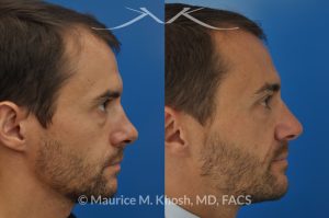 Photo of a patient before and after a procedure. Nose fracture - due to sports injury. Correction of the  deviated septum, placement of a left sided spreader graft, and right sided osteotomies to correct the displaced nasal bone