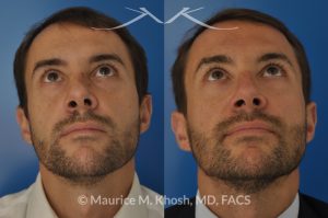 Photo of a patient before and after a procedure. Nose fracture - due to sports injury. Correction of the  deviated septum, placement of a left sided spreader graft, and right sided osteotomies to correct the displaced nasal bone