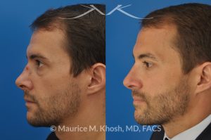 Photo of a patient before and after a procedure. Nose fracture - due to sports injury. Correction of the  deviated septum, placement of a left sided spreader graft, and right sided osteotomies to correct the displaced nasal bone