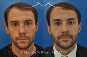 Photo of a patient before and after a procedure. Nose fracture - due to sports injury. Correction of the  deviated septum, placement of a left sided spreader graft, and right sided osteotomies to correct the displaced nasal bone