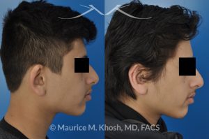 Photo of a patient before and after a procedure. Otoplasty - to fix over-projected right ear