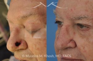 Photo of a patient before and after a procedure. Repair of Moh's defect of the left lower nose following excison of Basal Cell skin cancer. A local advancement flap was used for repair - before and after photos.