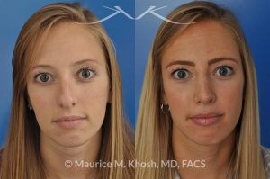 Photo of a patient before and after a procedure. Rhinoplasty to reduce a nose hump, elevate the nose tip, and refine the nose tip