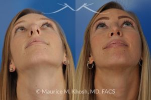 Photo of a patient before and after a procedure. Rhinoplasty to reduce a nose hump, elevate the nose tip, and refine the nose tip