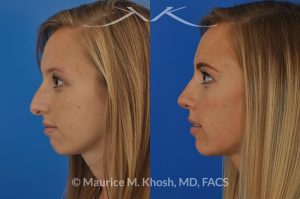 Photo of a patient before and after a procedure. Rhinoplasty to reduce a nose hump, elevate the nose tip, and refine the nose tip