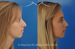 Photo of a patient before and after a procedure. Rhinoplasty to reduce a nose hump, elevate the nose tip, and refine the nose tip
