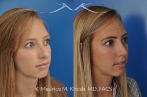 Photo of a patient before and after a procedure. Rhinoplasty to reduce a nose hump, elevate the nose tip, and refine the nose tip