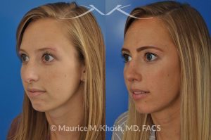 Photo of a patient before and after a procedure. Rhinoplasty to reduce a nose hump, elevate the nose tip, and refine the nose tip