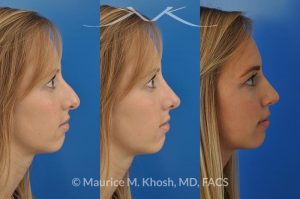 Photo of a patient before and after a procedure. Rhinoplasty to refine the nose tip and reduce a small hump. The left picture shows the before, the center picture shows the computer simulation, and the left one shows the post op result.