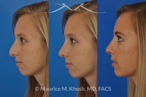 Photo of a patient before and after a procedure. Rhinoplasty to refine the nose tip and reduce a small hump. The left picture shows the before, the center picture shows the computer simulation, and the left one shows the post op result.