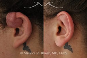 Photo of a patient before and after a procedure. Keloid of the upper aspect of the left ear due to piercing