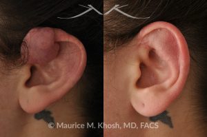 Photo of a patient before and after a procedure. Keloid of the upper aspect of the left ear due to piercing