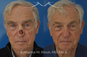 Photo of a patient before and after a procedure. Mohs repair of nose skin cancer with forehead flap - before and after photos.