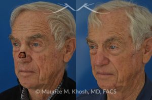 Photo of a patient before and after a procedure. Mohs repair of nose skin cancer with forehead flap - before and after photos.