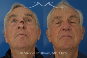 Photo of a patient before and after a procedure. Mohs repair of nose skin cancer with forehead flap