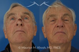 Photo of a patient before and after a procedure. Mohs repair of nose skin cancer with forehead flap - before and after photos.