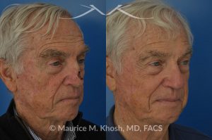 Photo of a patient before and after a procedure. Mohs repair of nose skin cancer with forehead flap - before and after photos.