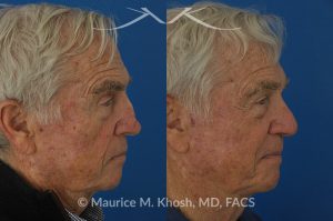 Photo of a patient before and after a procedure. Mohs repair of nose skin cancer with forehead flap - before and after photos.