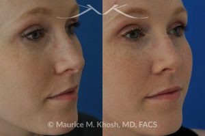 Photo of a patient before and after a procedure. Mole removal from cheek skin near the nose