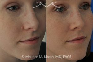 Photo of a patient before and after a procedure. Mole removal from cheek skin near the nose